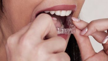 How Invisalign Aligners in Southampton Improve Dental Alignment