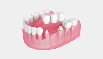Missing or Damaged Teeth? Discover Reliable Crown & Bridge Solutions